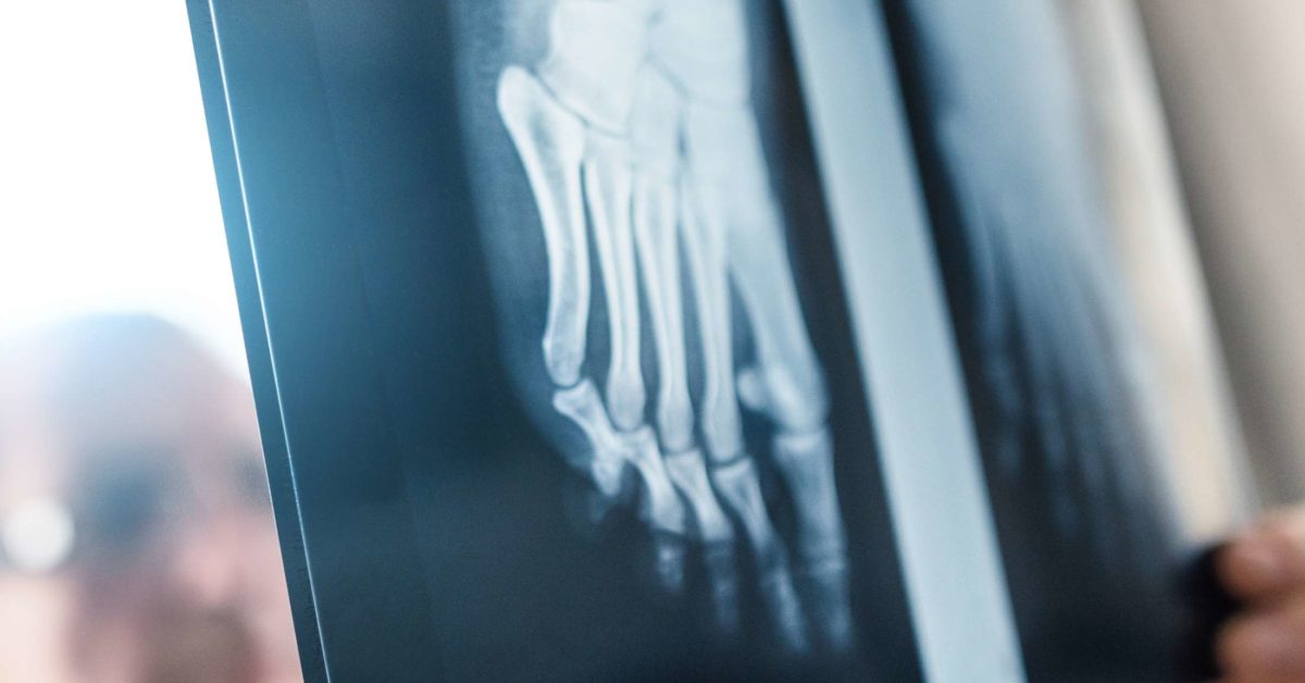 Foot bones: Anatomy, conditions, and more