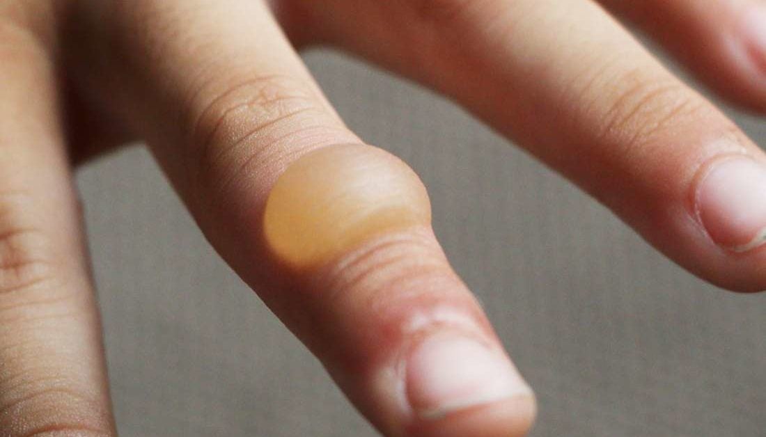 How To Treat A Skin Blister