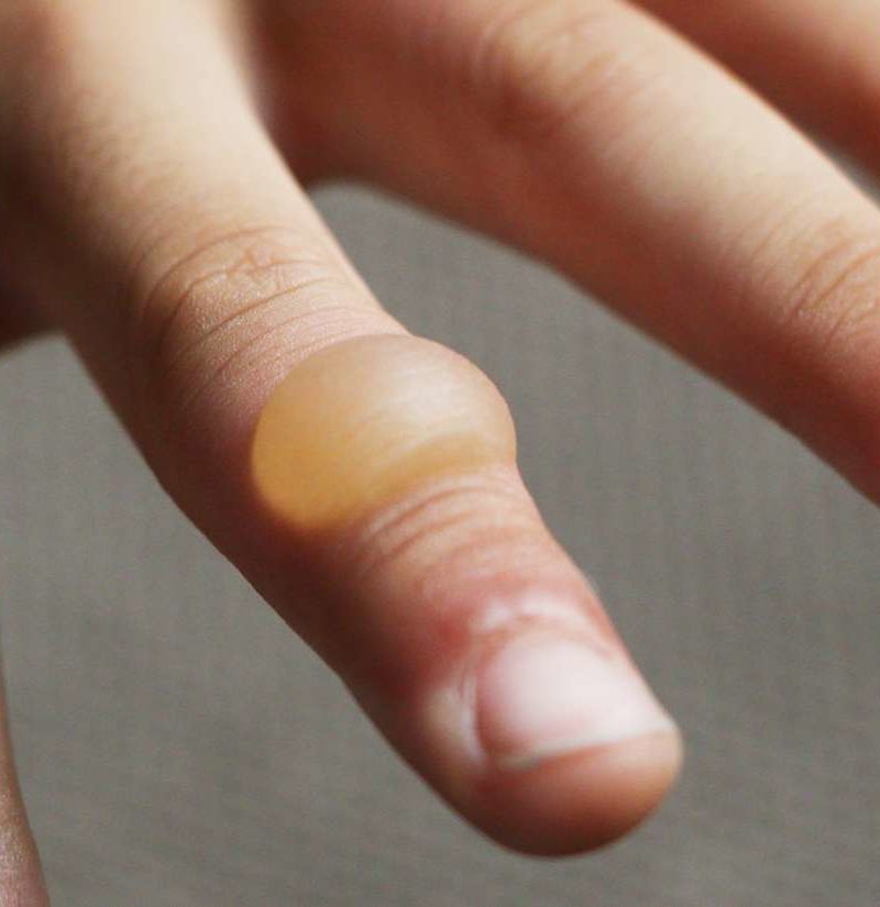 Burn blister First aid, treatment, and types of burns