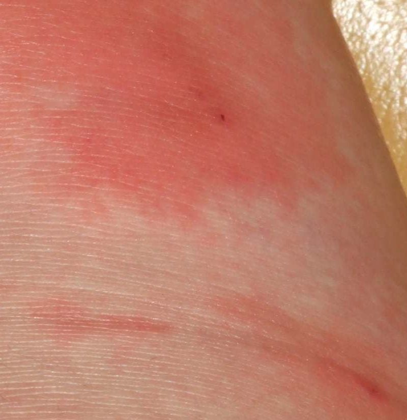 How To Tell If You Have A Fungal Infection On Skin