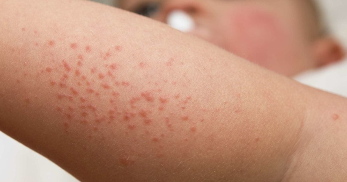 4-best-ways-to-treat-baby-heat-rash