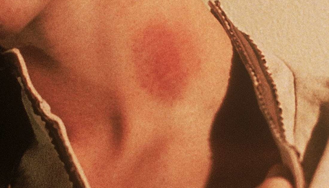 how to get rid of a hickey best home remedies