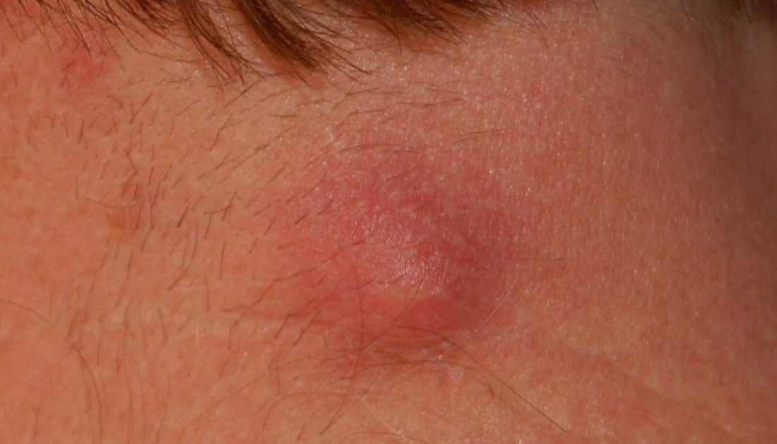 Lump on neck: Causes and pictures