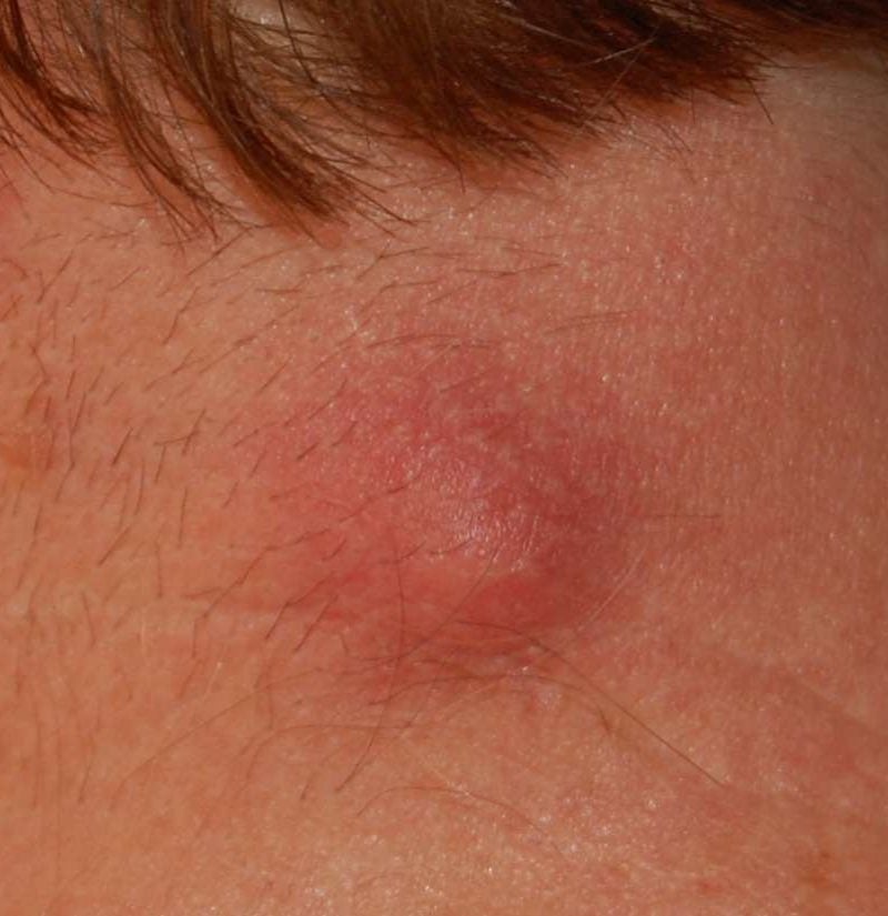 enlarged lymph node on back of neck