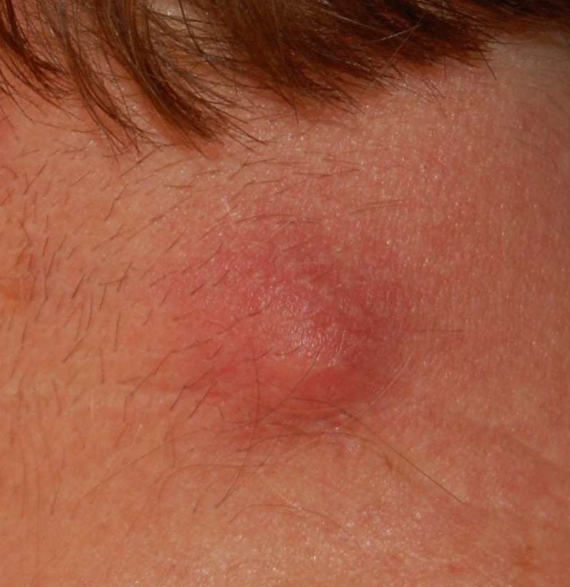 draining-cyst-on-back-of-neck-best-drain-photos-primagem-org