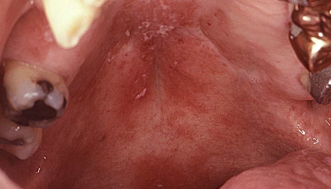 What Causes Red Blotches On Roof Of Mouth