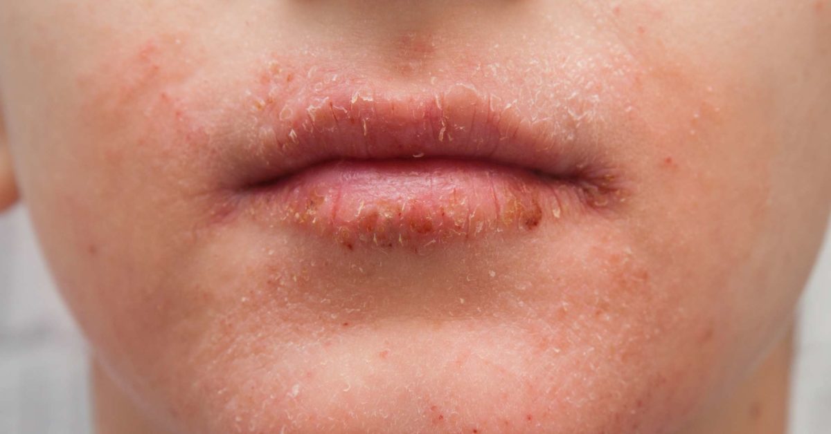 Dry Scaly Rash On Upper Lip