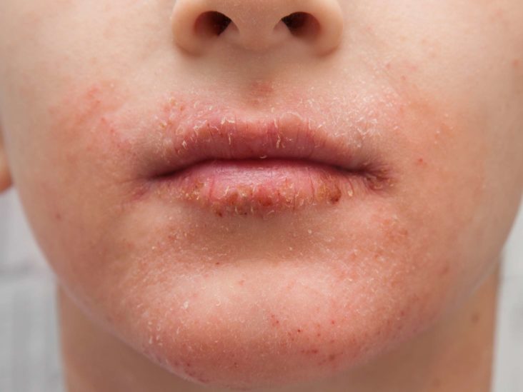 Dry Lips And Itching Skin | Sitelip.org