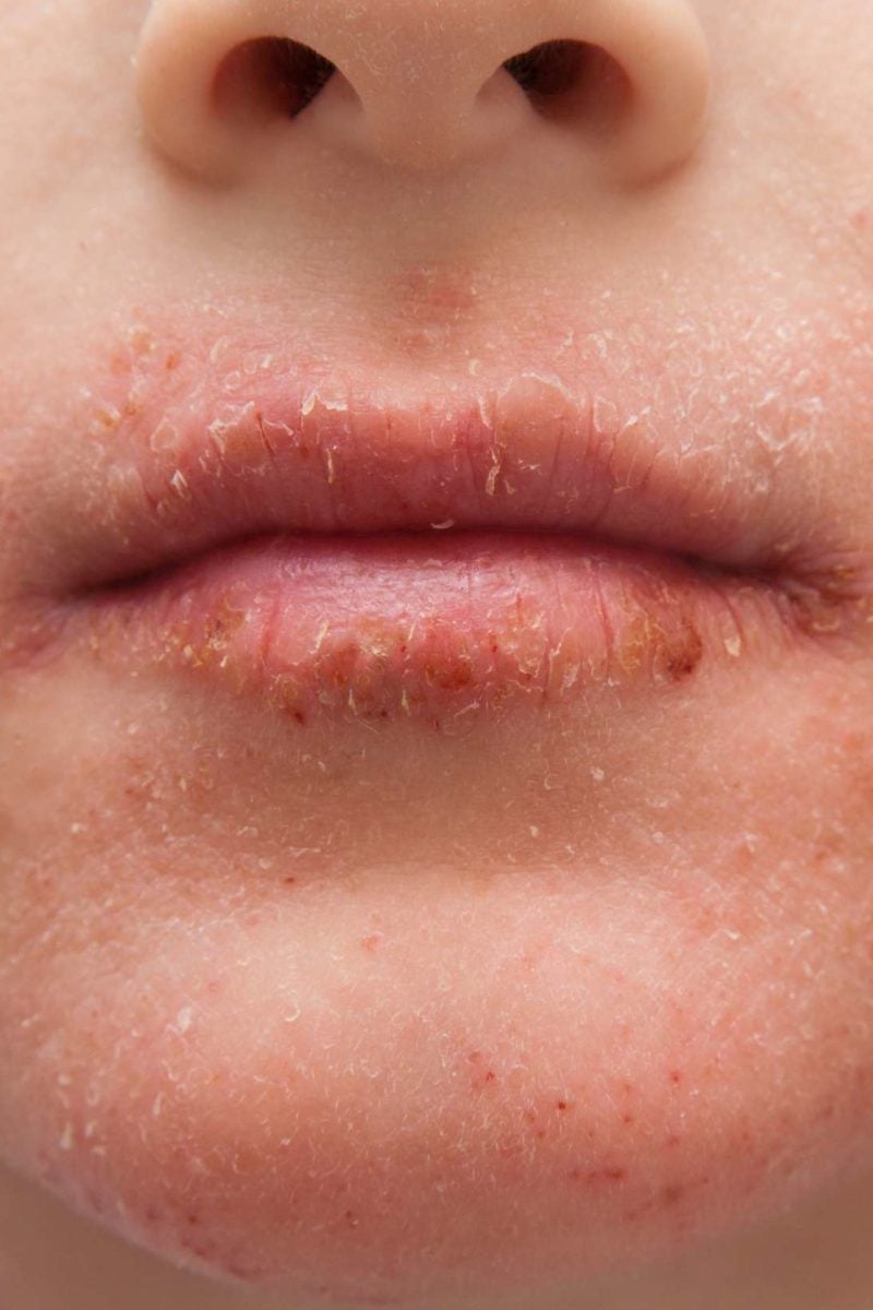 Flaky Skin On Face Around Mouth Red Rash Around Your Mouth Could Be