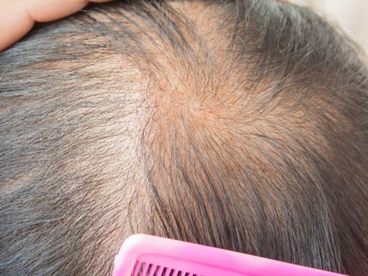 9 Best Ways To Stop Hair Loss