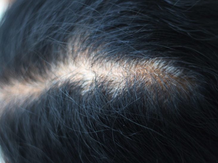 Can Dandruff Lead To Hair Loss The Link Causes And Treatments
