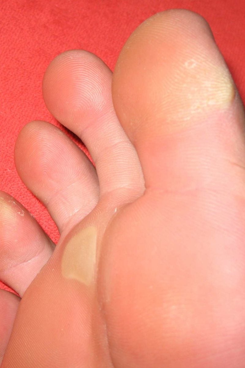 dry cracked yellow feet