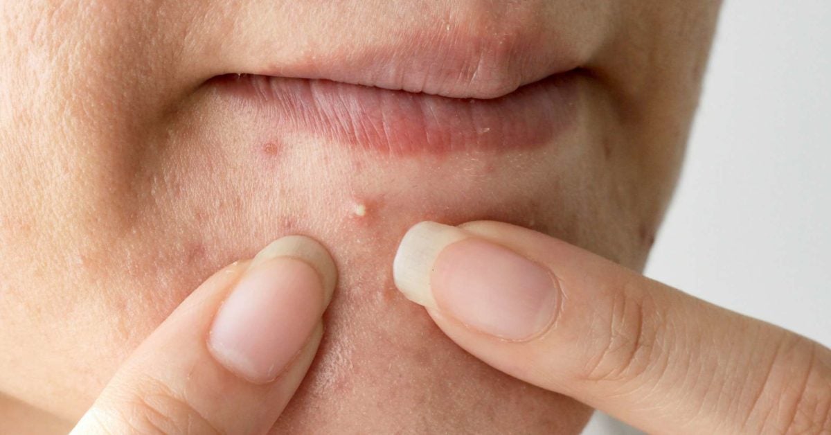 Pimples On The Chin What It Means And How To Get Rid Of Them