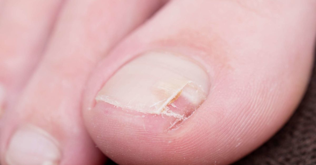 How to fix a split nail: Causes, treatment, and prevention