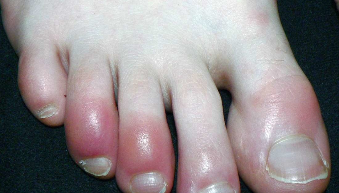 dry skin on toe knuckle