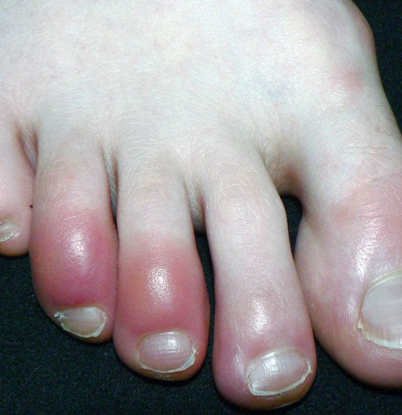 Why are my toes red? Causes, other 