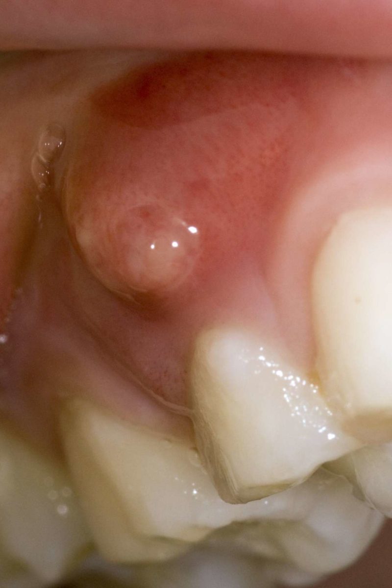 Gum Boils What They Are And How To Treat Them