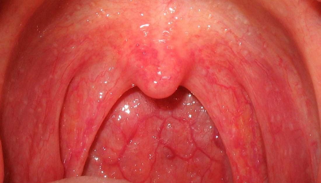 infections in adults Throat