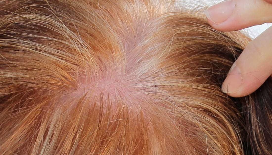 Prp For Hair Loss Does It Work And Is It Safe