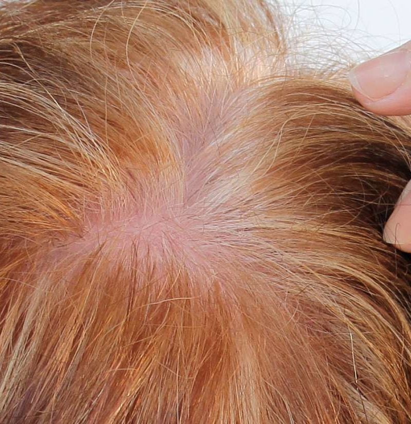 Prp For Hair Loss Does It Work And Is It Safe