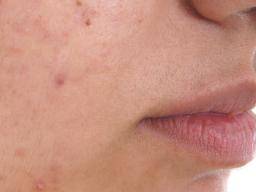 Acne Around Mouth Causes Prevention And Treatment