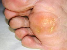 sore on the bottom of my foot