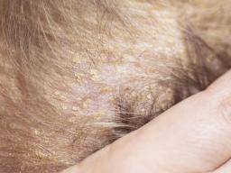 Seborrheic Dermatitis Hair Loss Causes And Treatment
