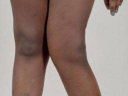Genu Valgum Knock Knees Causes And Treatment