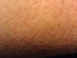 Ichthyosis vulgaris: Pictures, diagnosis, and treatment