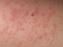 Ingrown Hair Cyst Treatments Causes And Prevention