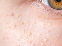 White Spots On The Face Possible Causes And Treatments
