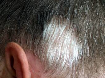 Poliosis Causes Symptoms And Treatment