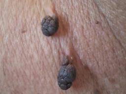 Mole Disappears Is It Normal