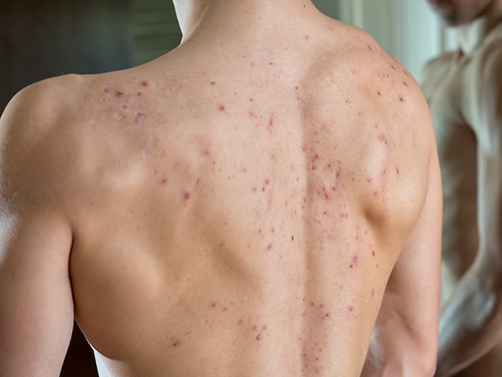 Cystic back acne: Causes and how to treat it