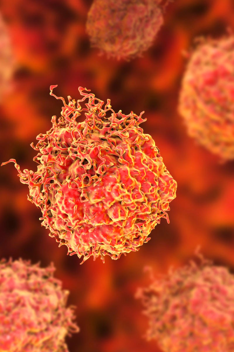 tumor-cell-type-identified-that-makes-prostate-cancer-more-aggressive