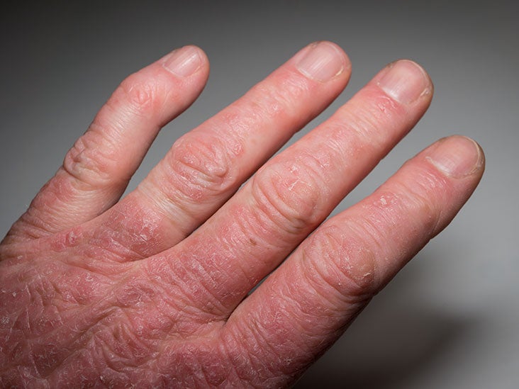 Psoriatic arthritis Symptoms, causes, treatment, and outlook