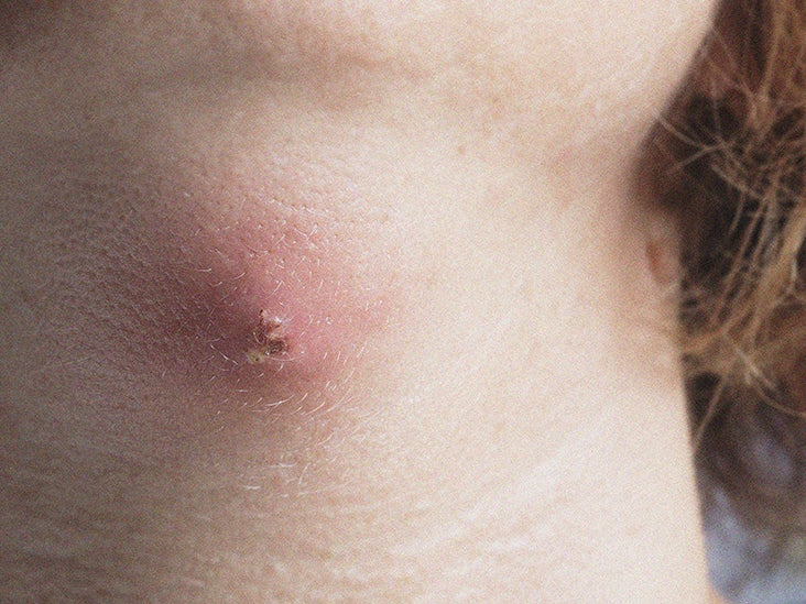 Skin abscess Pictures, symptoms, causes, and treatment