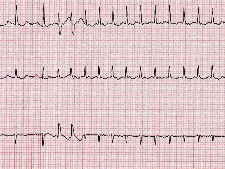 Heart palpitations: Causes, tests, and treatment