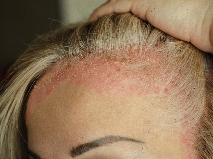 psoriasis scalp remove scales)